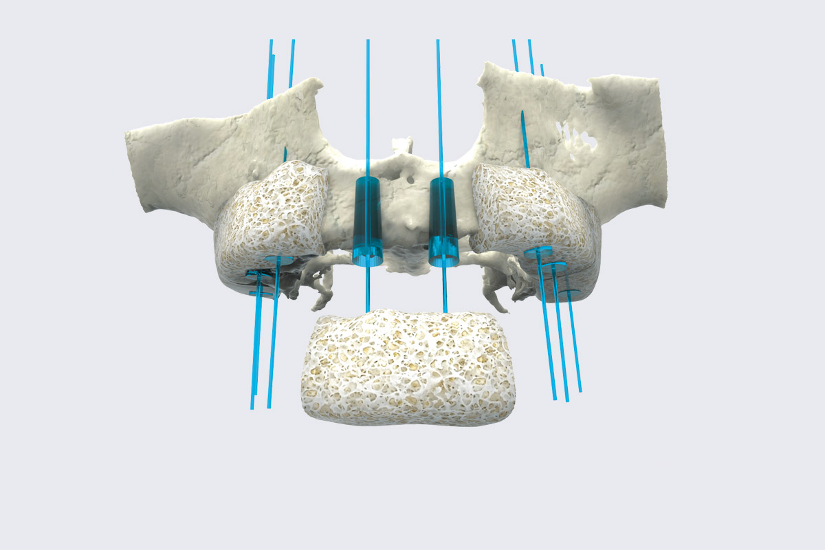 Instalação de implantes + enxerto ósseo liofilizado